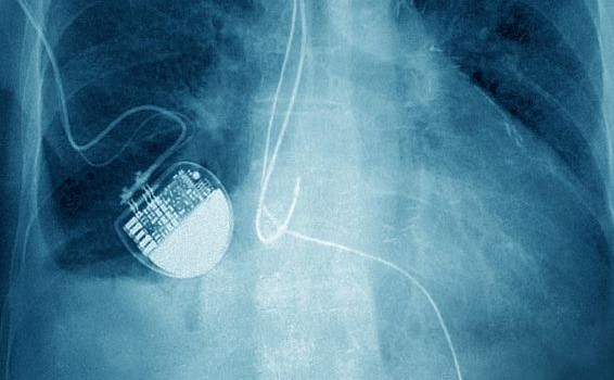 Közel fél millió szívritmus szabályozó viselője válhat a hekkerek áldozatává ! Forrás: https://www.cnet.com/news/fda-nearly-a-half-million-pacemakers-could-get-hacked/
