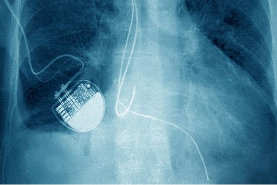 Közel fél millió szívritmus szabályozó viselője válhat a hekkerek áldozatává ! Forrás: https://www.cnet.com/news/fda-nearly-a-half-million-pacemakers-could-get-hacked/